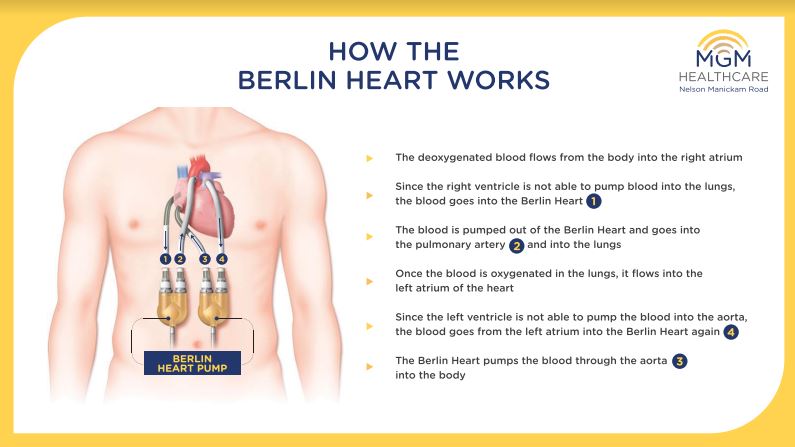 How the Berlin heart works