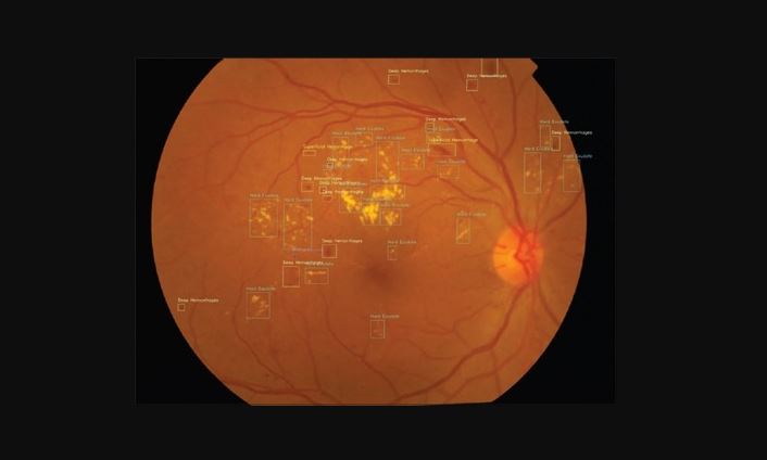 Intel Powered AI Solution Helps Reduce Diabetic Vision Loss
